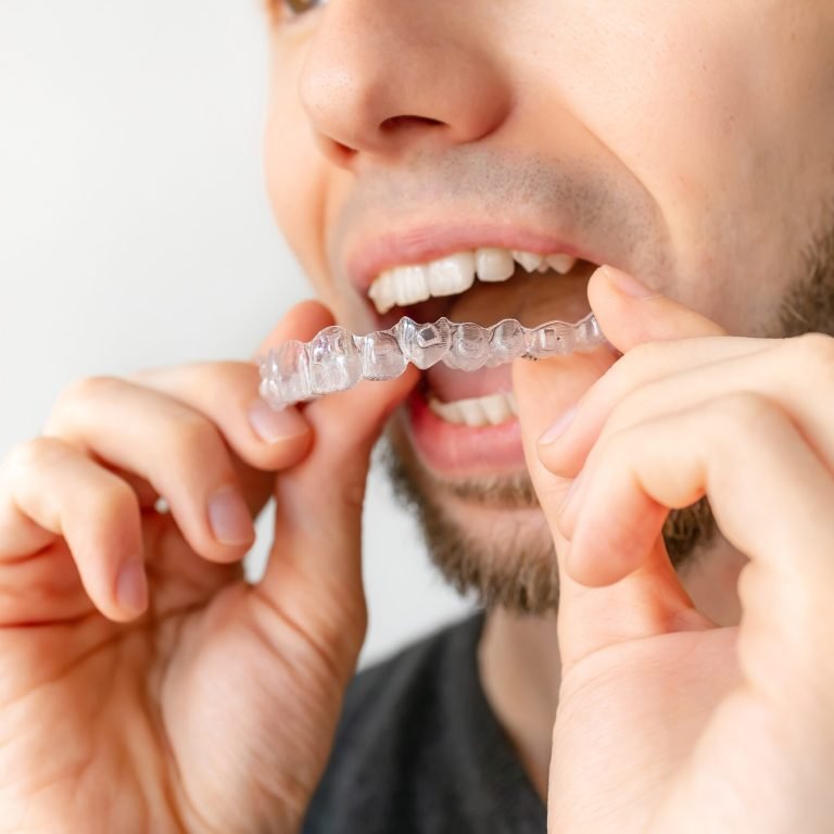 Male hand applying dental aligner retainer of dental clinic for beautiful teeth treatment. Orthodontic removable straighteners in dentist office