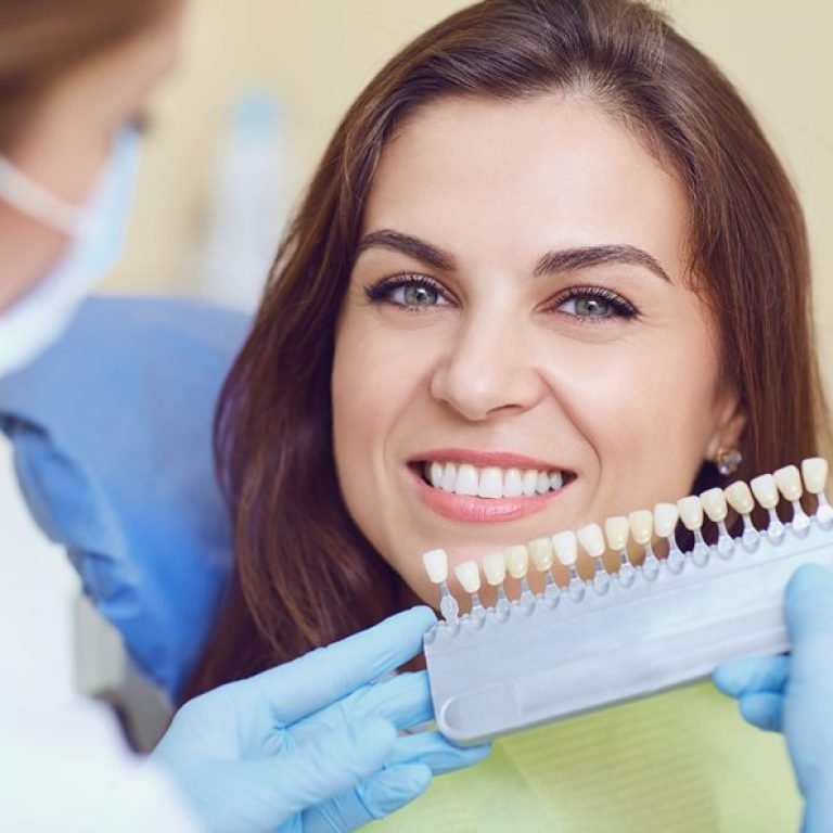 Dental-Veneers-891x594