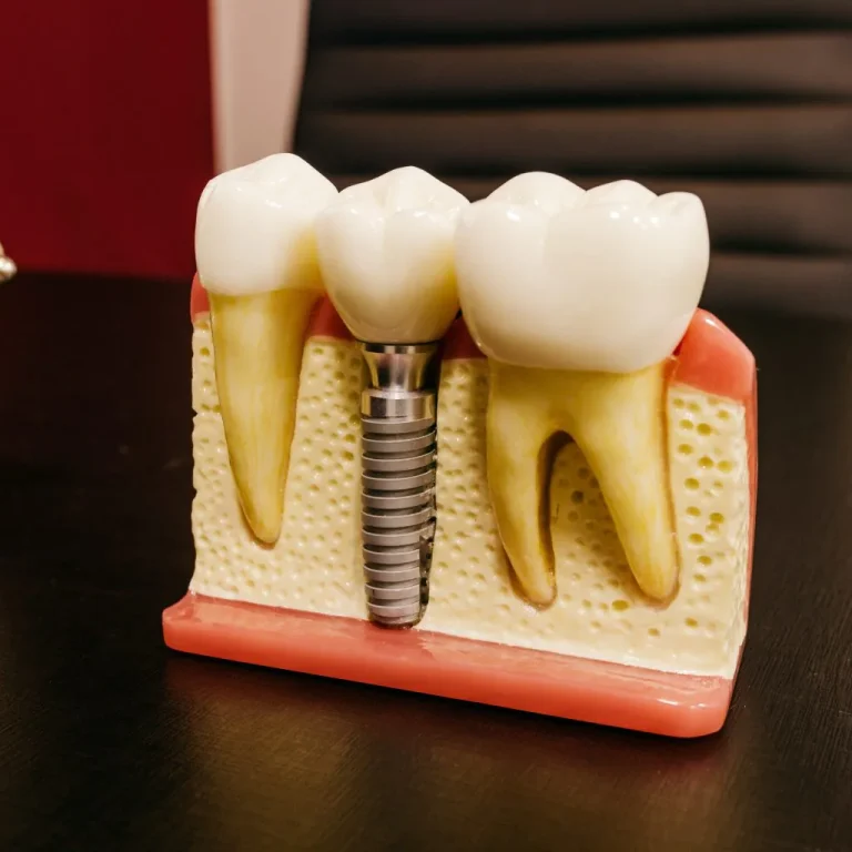 dental-implants-1536x1024.jpg